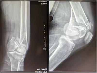 Clinical effect of closed reduction minimally invasive fixation in intra-articular comminuted fractures of the femoral condyle